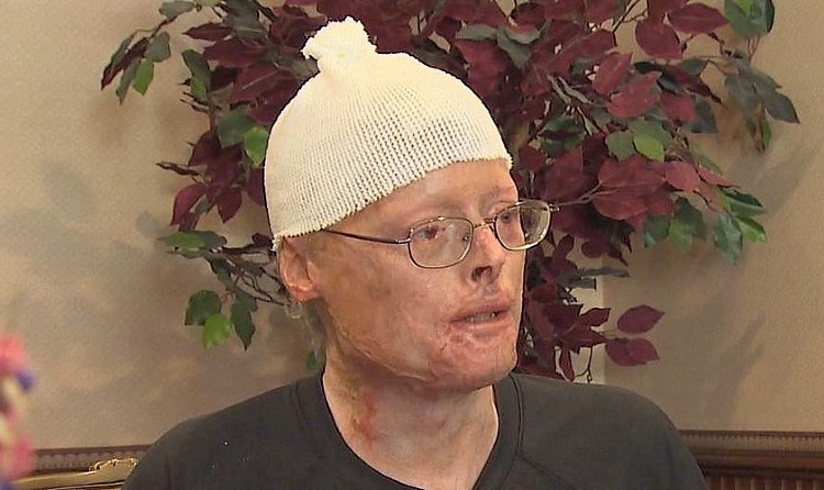 Jimmy Carter teve que passar por cerca de 20 cirurgias de reconstituição I Foto: Facebook